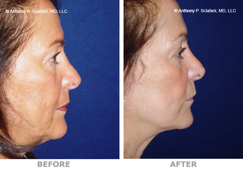 Facelift-Brow-R-Lateral.jpg